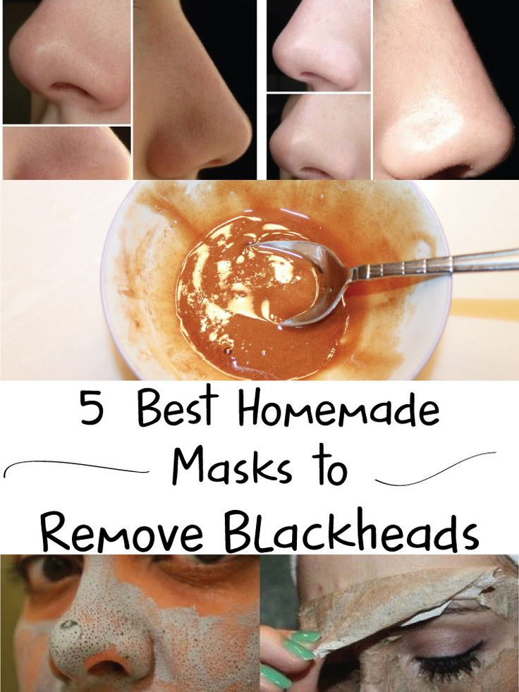 Best DIY Blackhead Mask
 5 Best Homemade Masks to Remove Blackheads
