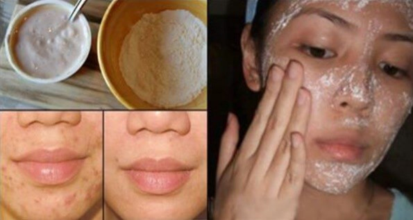 DIY Acne Scar Mask
 homemade face mask for acne scar Archives I Love Home