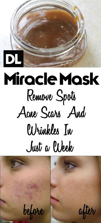 DIY Acne Scar Mask
 Homemade Face Mask to Get Rid of Spots Acne Scars and