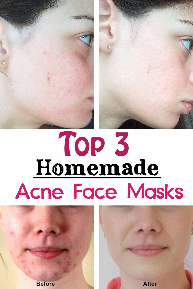 DIY Mask For Acne
 Top 3 Homemade Acne Face Masks 16