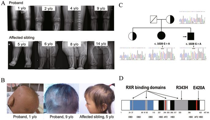 Hair Loss In Children Vitamin Deficiency
 Functional Analysis of VDR Gene Mutation R343H in A Child