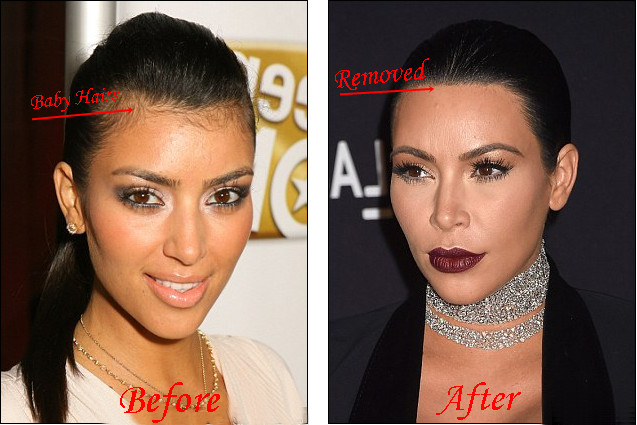 Kim.Kardashian Baby Hair
 Kim Kardashian Laser Hair Removal Before And After