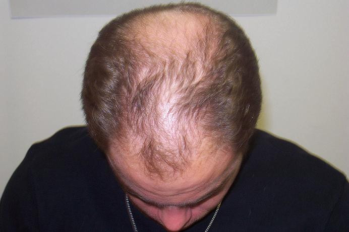 Male Pattern Baldness Hairstyle
 Hair Transplant & Hair Loss Interview with an Expert The